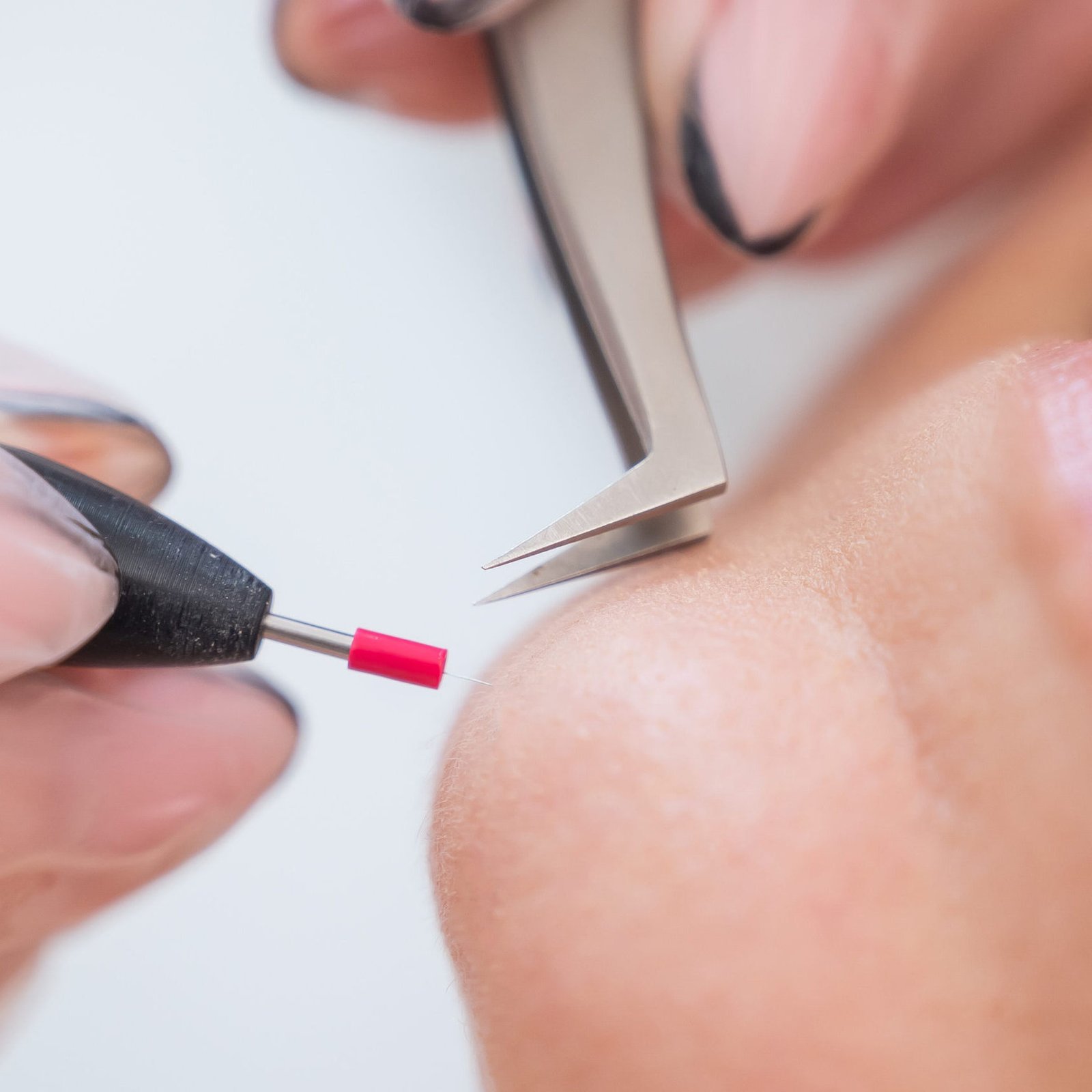 Woman on electro epilation of the face. Hardware permanent removal of unwanted hair on the chin Woman on electro epilation of the face. Hardware permanent removal of unwanted hair on the chin.